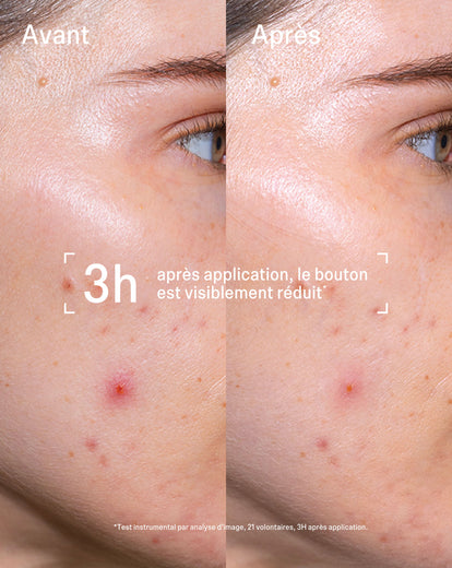 Tratamiento Flash Imperfecciones