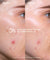 Tratamiento Flash Imperfecciones