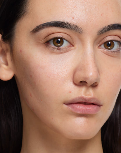 Tratamiento Flash Imperfecciones
